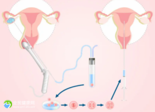 辅助生殖科普